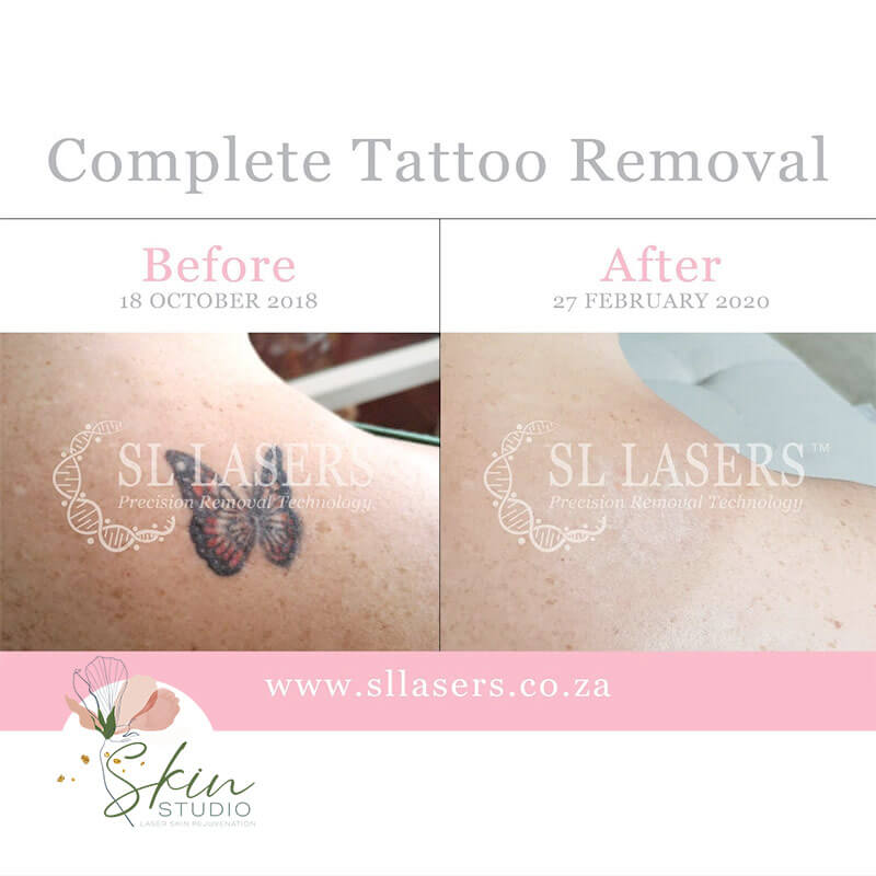 Skin Studio Menlo Park Laser Skin Treatments in Menlo Park